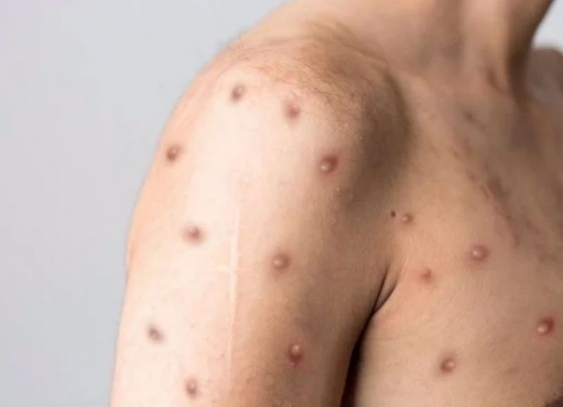 Confirmaron el quinto caso de viruela del mono en la provincia de Santa Fe